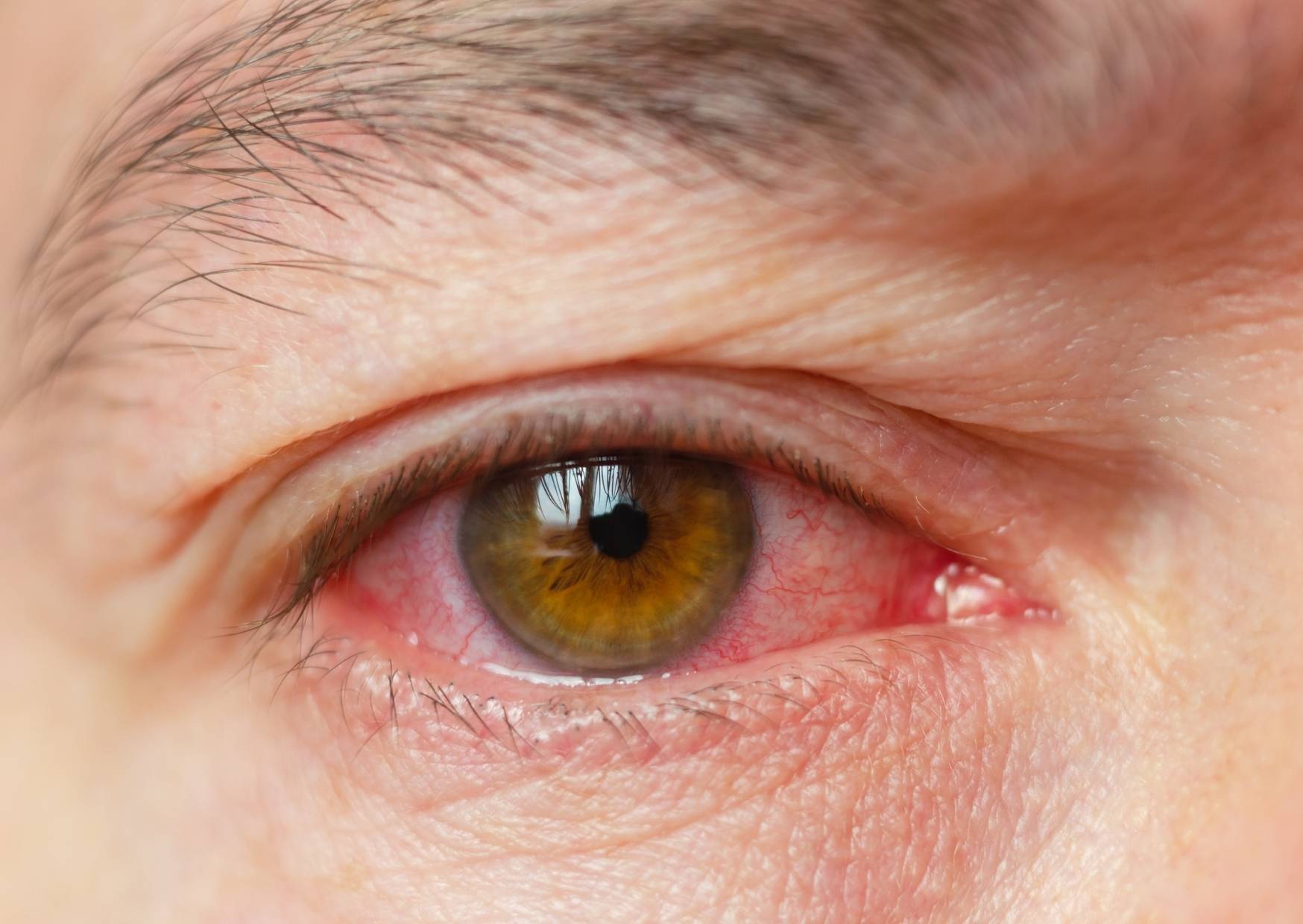 Adenovirus-bedingte Bindehautentz&uuml;ndung mit ger&ouml;tetem Auge